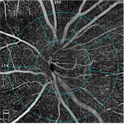 Precision (repeatability and reproducibility) of papillary and peripapillary vascular density measurements using optical coherence tomography angiography in children